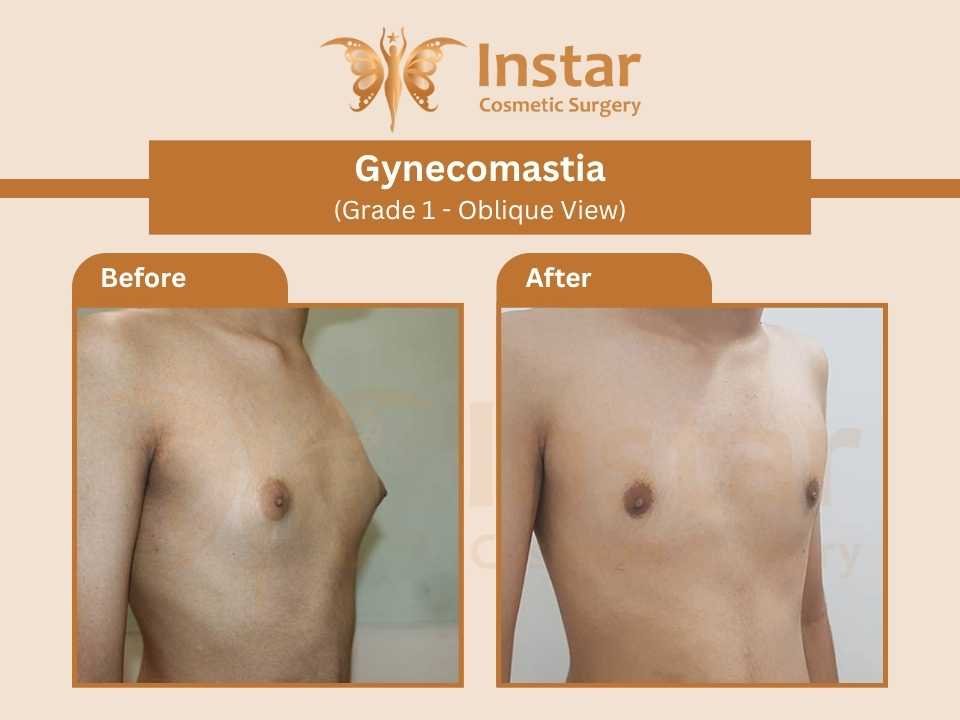 Gynecomastia (Grade 1 - Oblique View)